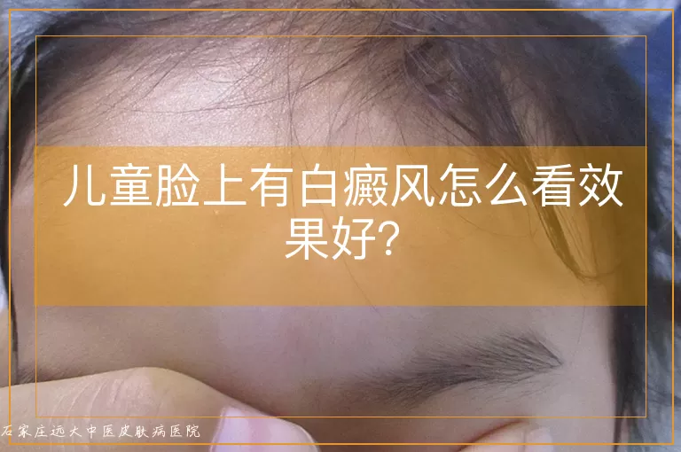 儿童脸上有白癜风怎么看效果好？