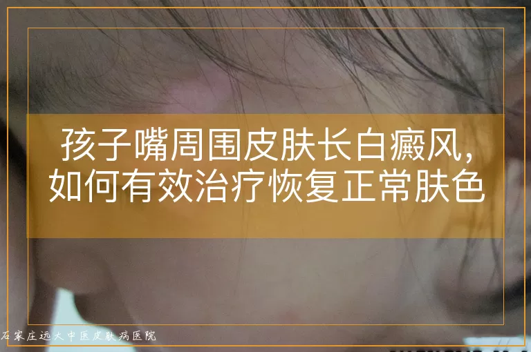 孩子嘴周围皮肤长白癜风，如何有效治疗恢复正常肤色？