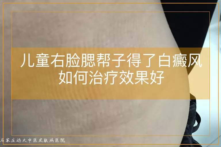 儿童右脸腮帮子得了白癜风如何治疗效果好