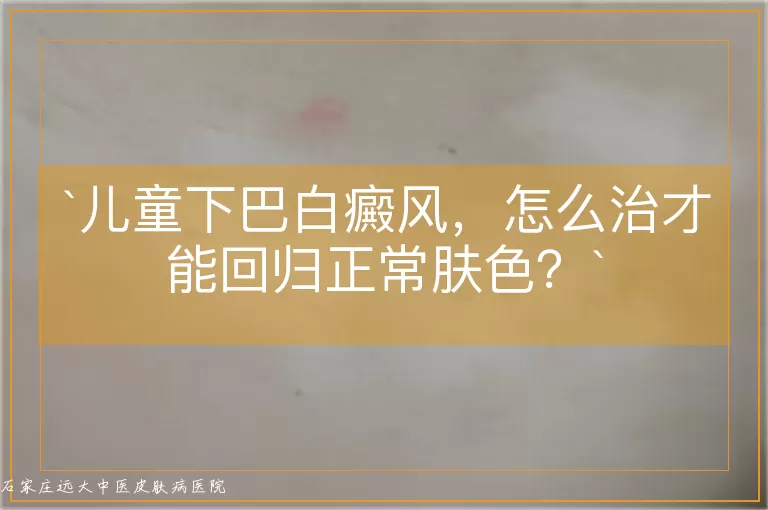 儿童下巴白癜风,怎么治才能回归正常肤色?