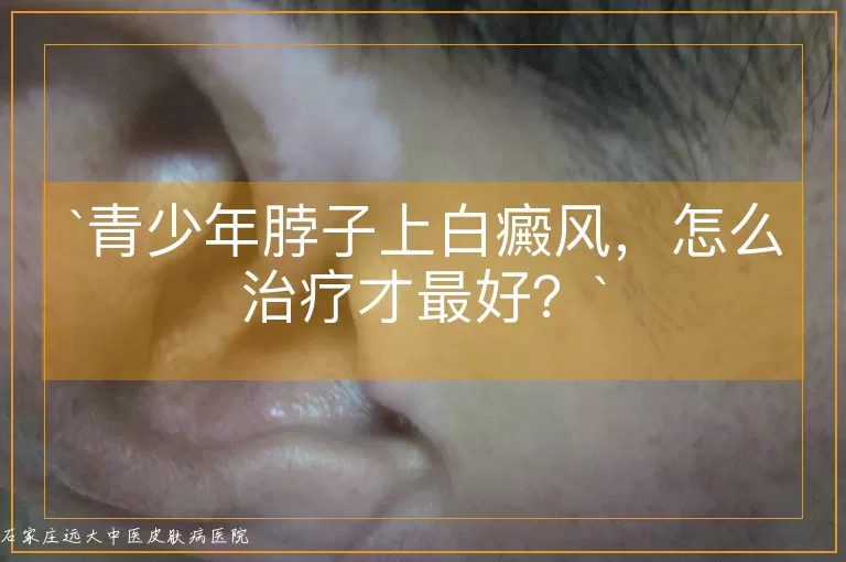 青少年脖子上白癜风，怎么治疗才最好？