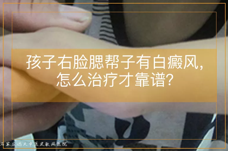 孩子右脸腮帮子有白癜风，怎么治疗才靠谱？