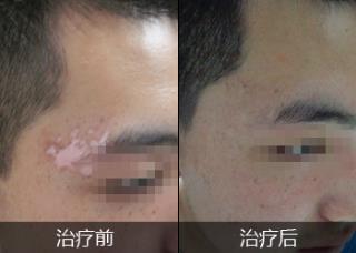 河北招致白癜风发病的要素是什么