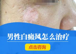 腰部白癜风污染吗