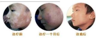 白癜风好转的最后迹象