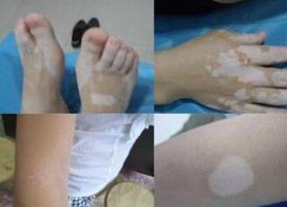 病因讨论，白癜风终究因何发生