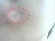 白癫疯用药后出现什么症状表示有好转