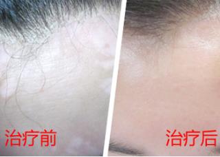 儿童白癜风的原因都有哪些