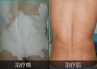 白癜风腹部症状会聚集吗