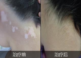 得了颈部白斑病该怎样办