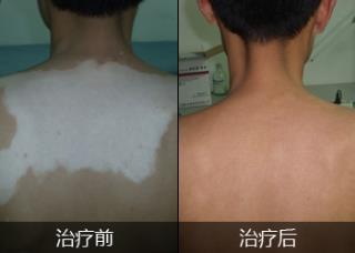 白癜风初期什么症状白癜风初期有什么症状怎样确诊白癜风