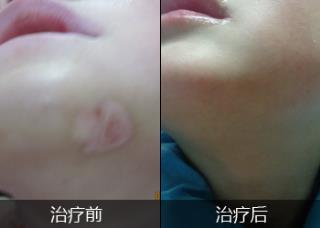 出现了白点和白斑就肯定是白癜风吗
