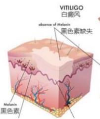 招致白癜风发生是有什么缘由呢
