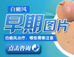 河北背部出现白癜风的缘由