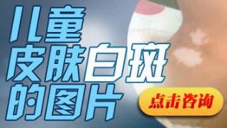 白癜风初期治疗费用高吗
