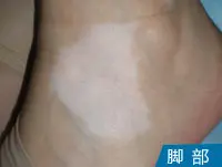 脚背皮肤白斑案例